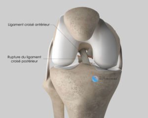 Ligamentoplastie du Ligament Croisé Postérieur Docteur Matthieu Meyer