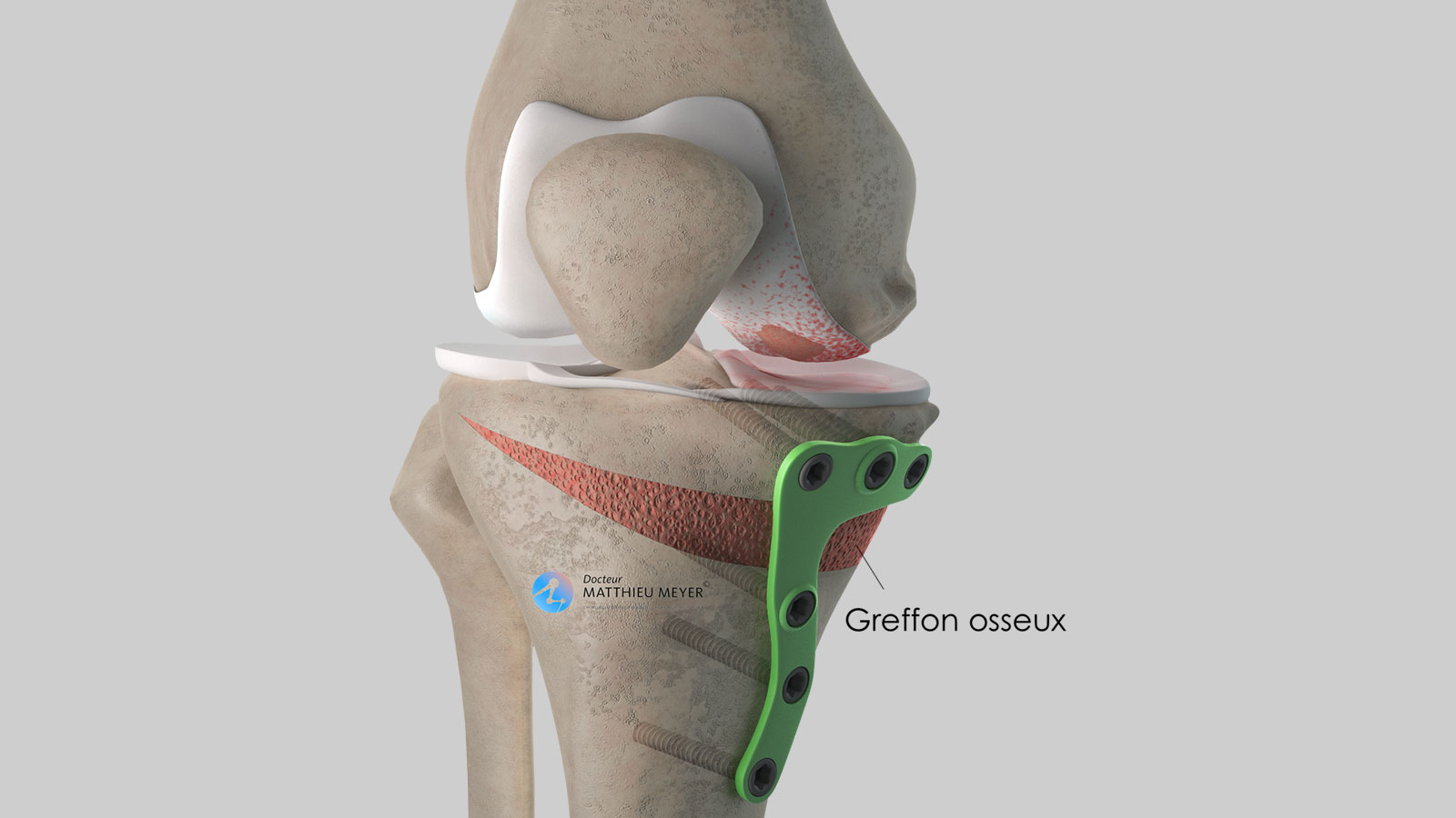 L'ostéotomie tibiale de valgisation de genou par ouverture interne -  Docteur Matthieu Meyer